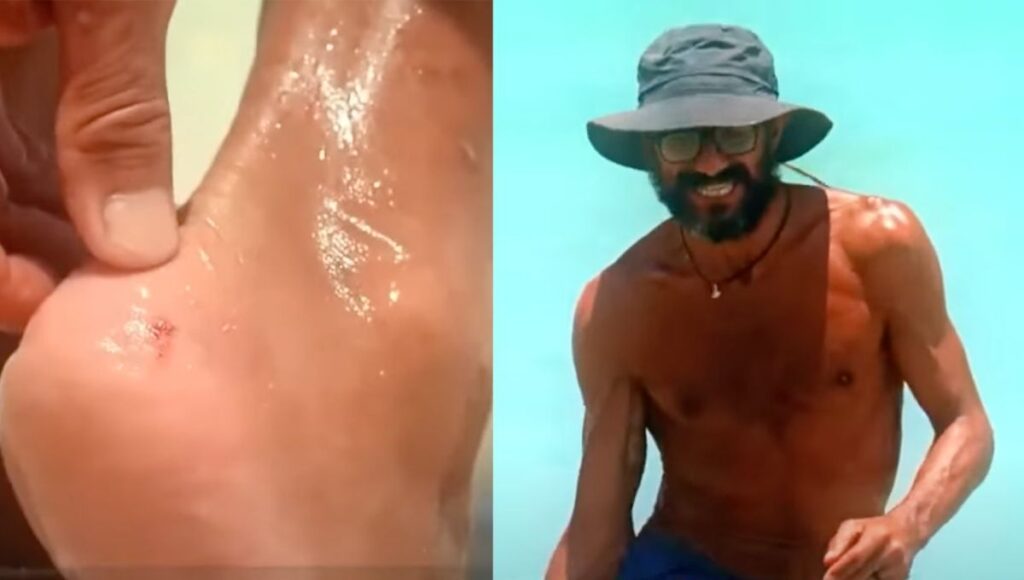 como esta la salud de rasta despues de la picadura de mantarraya
